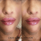 Dermal lip fillers in Bromley