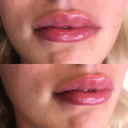 Dermal lip fillers in Bromley